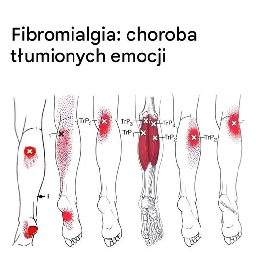Fibromialgia: Cosa Devi Sapere se Ti Senti Sempre Stanco e Hai Dolori Incontrollabili