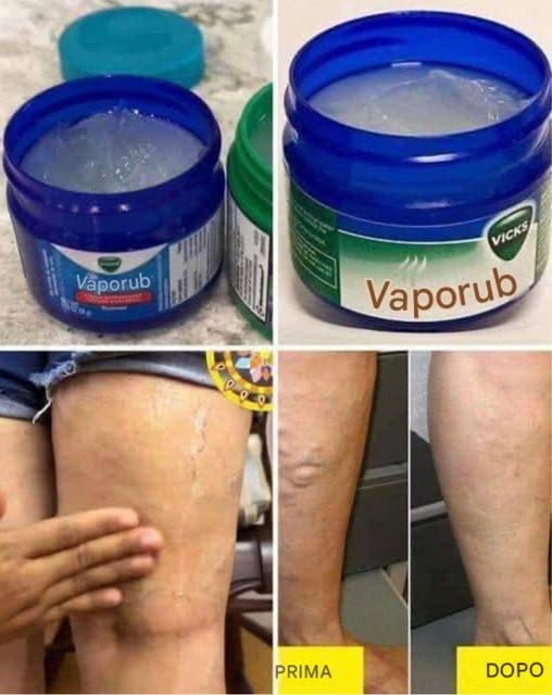 Ho 35 anni e le mie cosce e gambe erano ricoperte di vene varicose