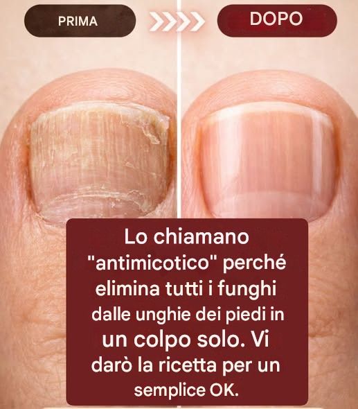 2 GOCCE DI ORIGANO SUL MICO DELLE UNGHIE E LO ELIMINA